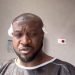 Peter Okoye undergoes hair transplant to eradicate baldness